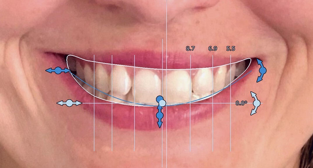 Exocad Smile Creator
