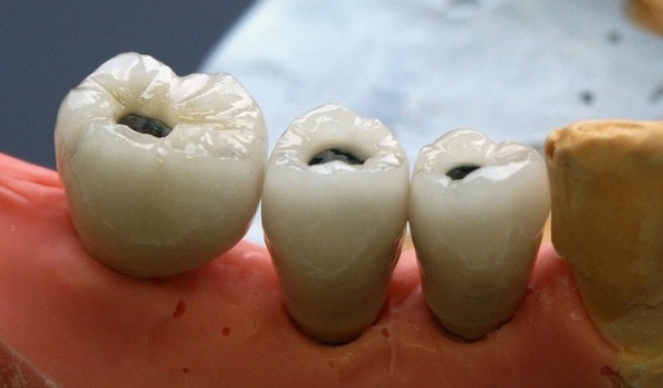 implant